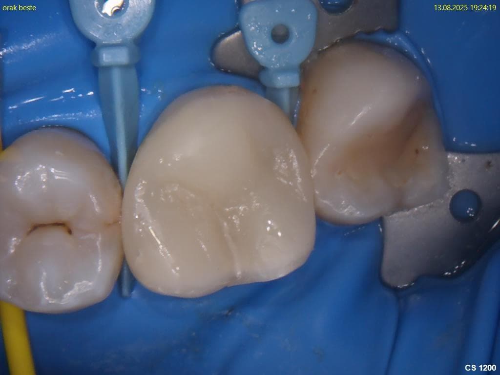 Endodontics (Root Canal Treatments)
