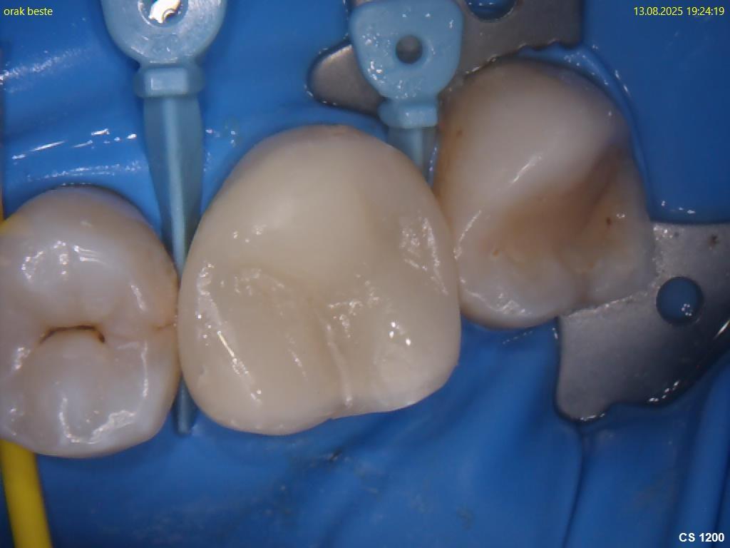 Endodontie (Wurzelkanalbehandlungen)